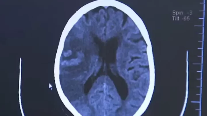 AVC mata 1 brasileiro a cada 6 minutos, e 80% dos casos poderiam ser evitados