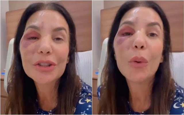 Ivete Sangalo passa por cirurgia após queda e fratura no rosto