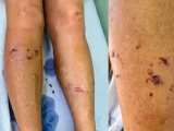 Mulher é atacada por raposa durante caminhada em Cruz das Almas