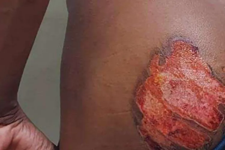 Acusados de marcar jovem negro e surdo-mudo com ferro quente nas nádegas são presos em Livramento de Nossa Senhora